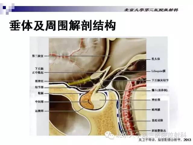 【病例】淋巴细胞性垂体炎1例MR影像表现