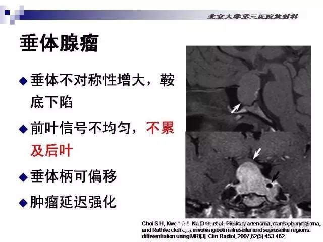 【病例】淋巴细胞性垂体炎1例MR影像表现
