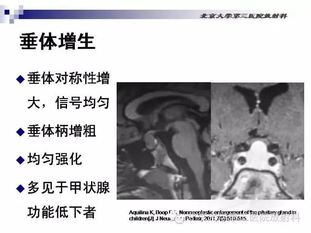【病例】淋巴细胞性垂体炎1例MR影像表现
