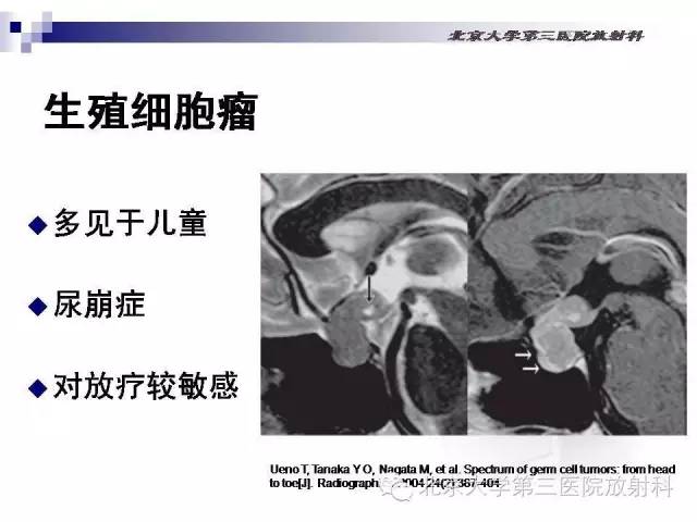 【病例】淋巴细胞性垂体炎1例MR影像表现