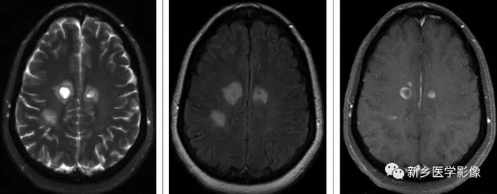 颅内10种多发结节样强化病变总结 颅内10种多发结节样强化病变总结