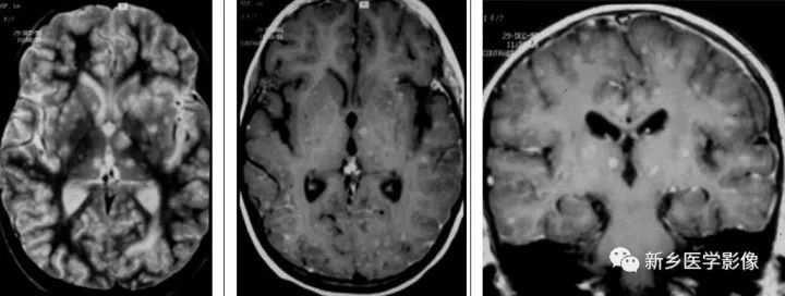 颅内10种多发结节样强化病变总结 颅内10种多发结节样强化病变总结