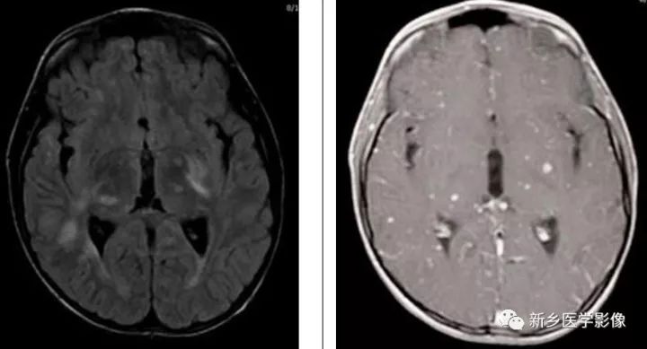 颅内10种多发结节样强化病变总结 颅内10种多发结节样强化病变总结