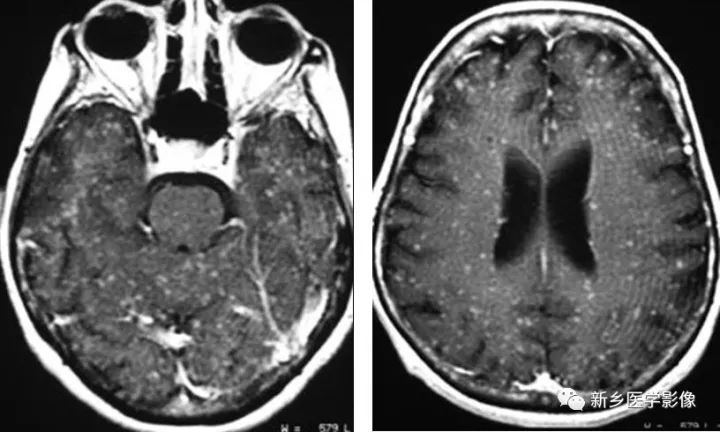 颅内10种多发结节样强化病变总结 颅内10种多发结节样强化病变总结