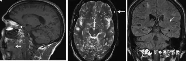 颅内10种多发结节样强化病变总结 颅内10种多发结节样强化病变总结
