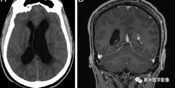 颅内10种多发结节样强化病变总结 颅内10种多发结节样强化病变总结