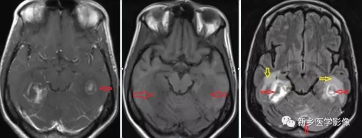 颅内10种多发结节样强化病变总结 颅内10种多发结节样强化病变总结