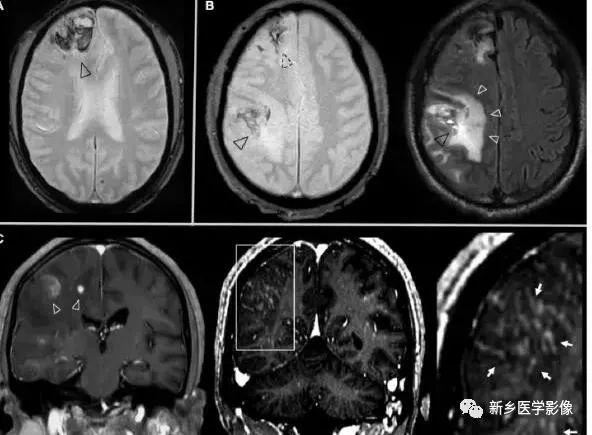 颅内10种多发结节样强化病变总结 颅内10种多发结节样强化病变总结