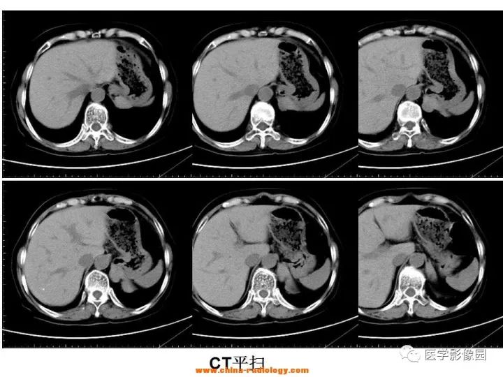 【病例】膈肌畸胎瘤1例CT 【病例】膈肌畸胎瘤1例CT