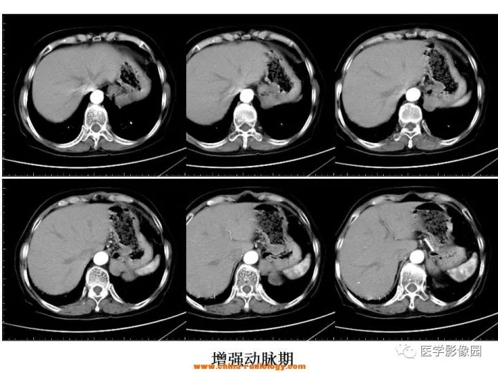 【病例】膈肌畸胎瘤1例CT 【病例】膈肌畸胎瘤1例CT