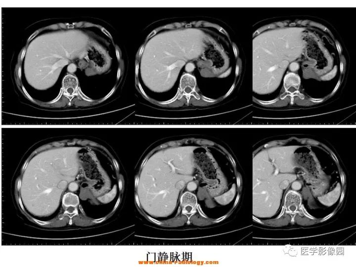 【病例】膈肌畸胎瘤1例CT