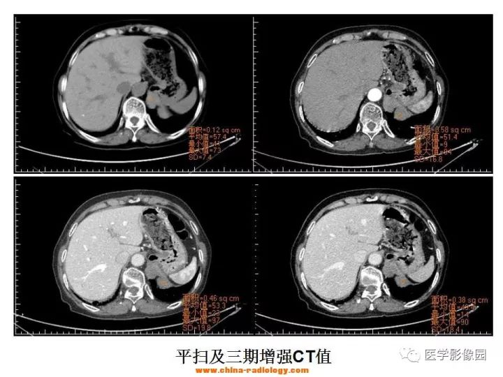 【病例】膈肌畸胎瘤1例CT 【病例】膈肌畸胎瘤1例CT
