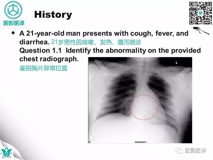 【病例】降主动脉胸段真菌性动脉瘤包裹性破裂1例
