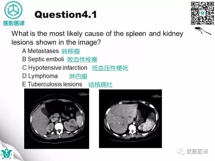 【病例】降主动脉胸段真菌性动脉瘤包裹性破裂1例