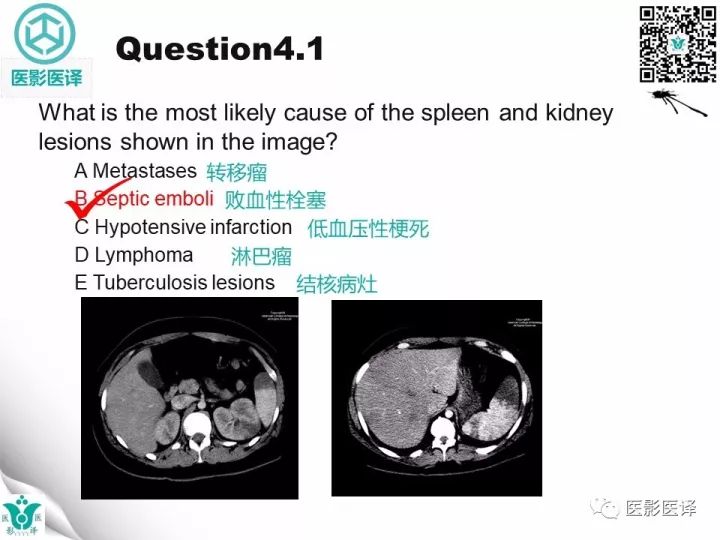 【病例】降主动脉胸段真菌性动脉瘤包裹性破裂1例
