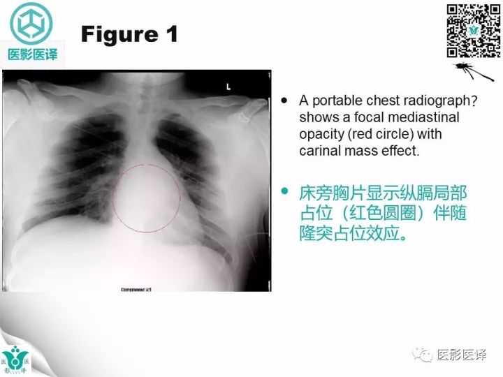 【病例】降主动脉胸段真菌性动脉瘤包裹性破裂1例