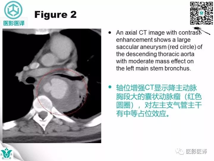 【病例】降主动脉胸段真菌性动脉瘤包裹性破裂1例