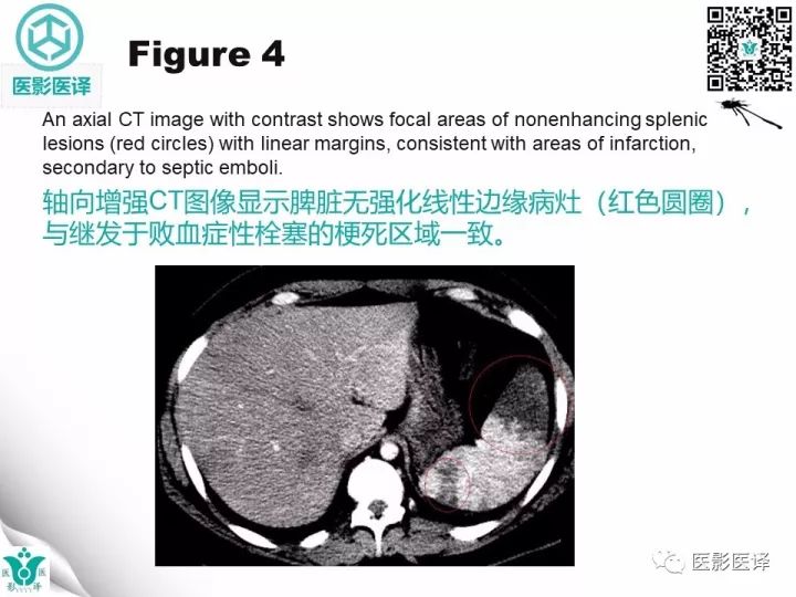 【病例】降主动脉胸段真菌性动脉瘤包裹性破裂1例