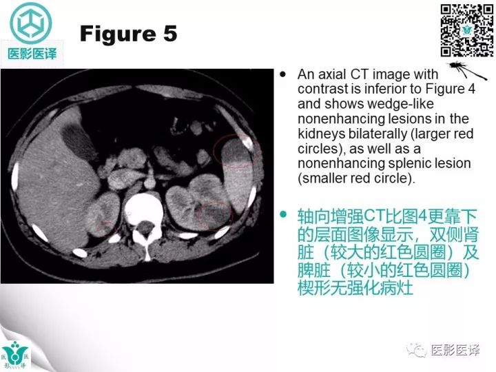 【病例】降主动脉胸段真菌性动脉瘤包裹性破裂1例