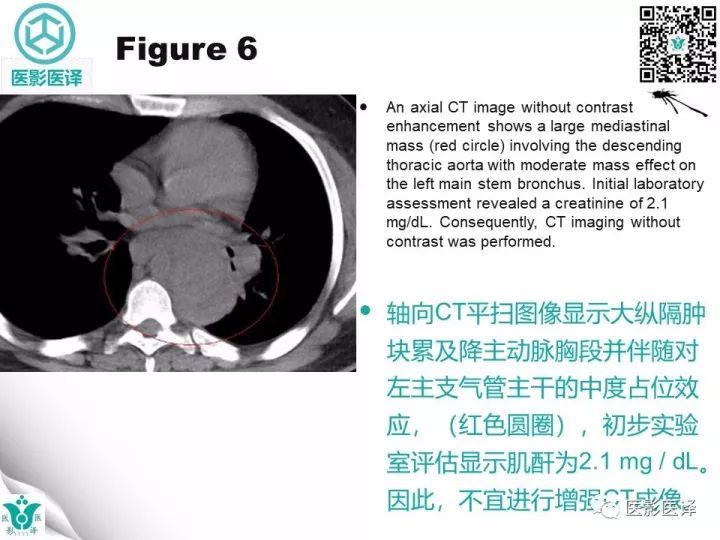 【病例】降主动脉胸段真菌性动脉瘤包裹性破裂1例