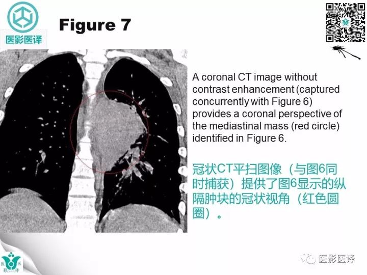 【病例】降主动脉胸段真菌性动脉瘤包裹性破裂1例