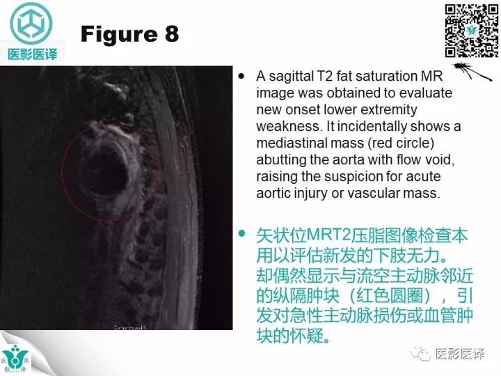 【病例】降主动脉胸段真菌性动脉瘤包裹性破裂1例