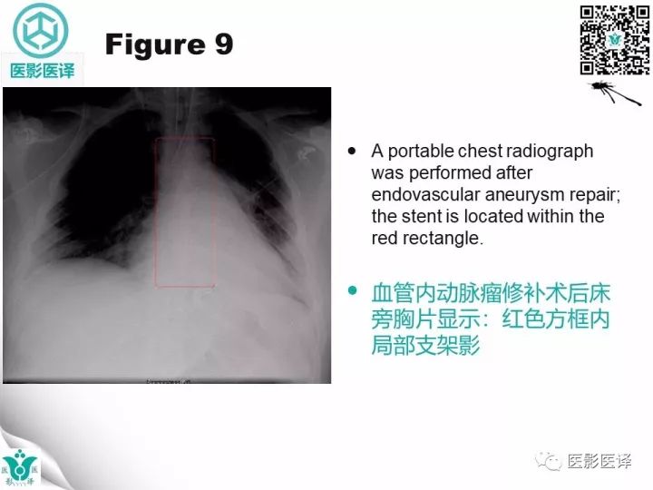 【病例】降主动脉胸段真菌性动脉瘤包裹性破裂1例