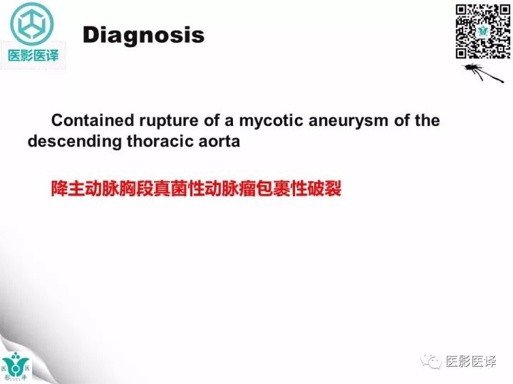 【病例】降主动脉胸段真菌性动脉瘤包裹性破裂1例