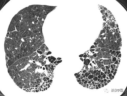 HRCT影像:纤维化和蜂窝样变之特发性肺纤维化 (IPF) HRCT影像:纤维化和蜂窝样变之特发性肺纤维化 (IPF)
