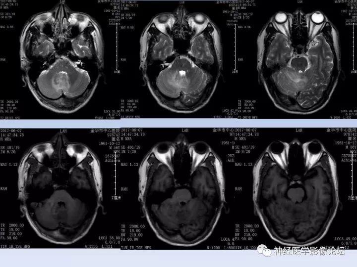 【病例】表现为结节的小脑胶母1例MR