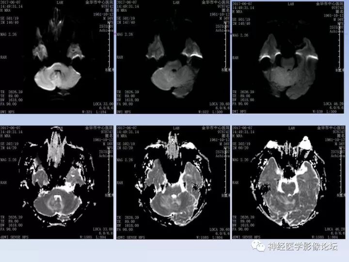 【病例】表现为结节的小脑胶母1例MR