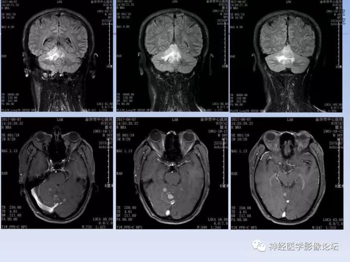【病例】表现为结节的小脑胶母1例MR