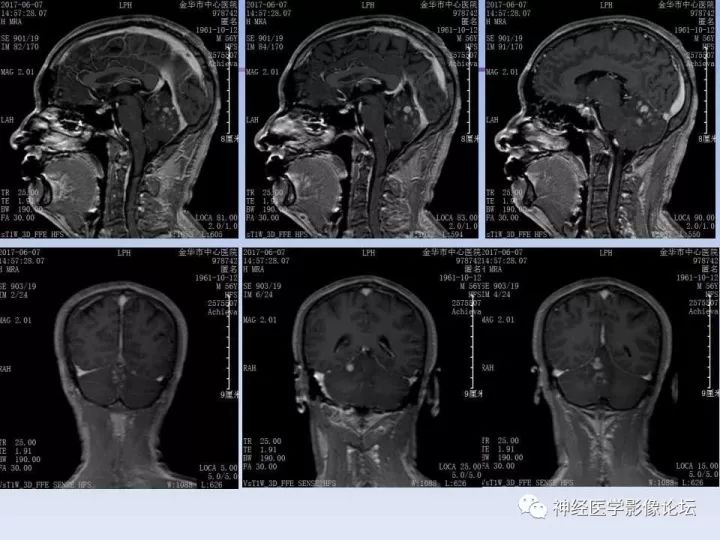 【病例】表现为结节的小脑胶母1例MR