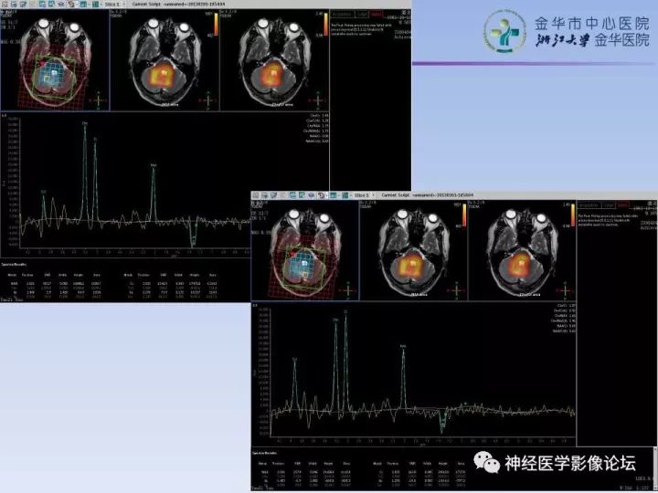 【病例】表现为结节的小脑胶母1例MR