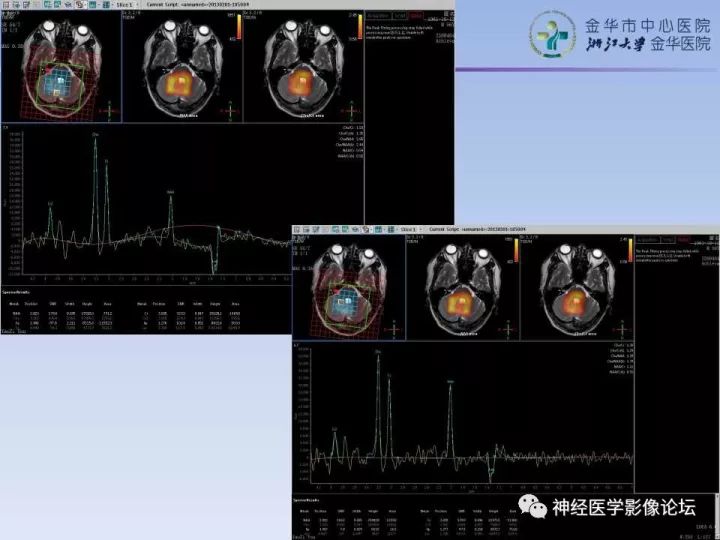 【病例】表现为结节的小脑胶母1例MR
