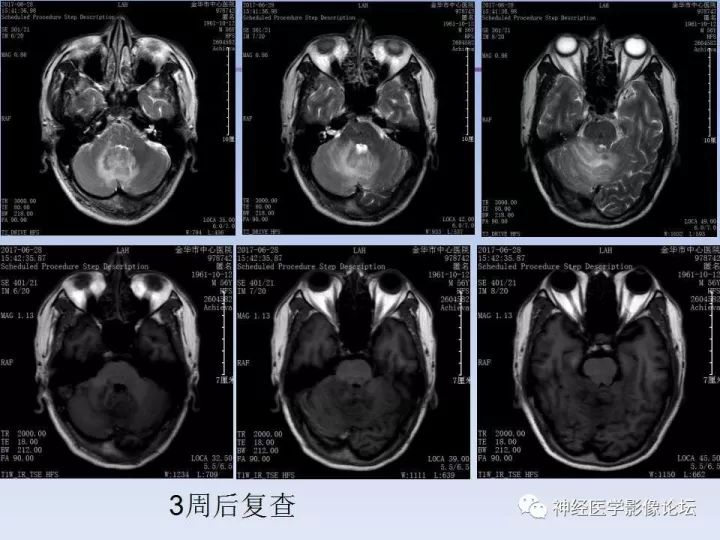 【病例】表现为结节的小脑胶母1例MR