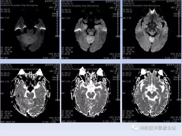 【病例】表现为结节的小脑胶母1例MR