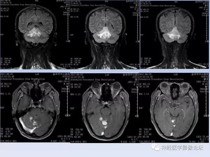 【病例】表现为结节的小脑胶母1例MR