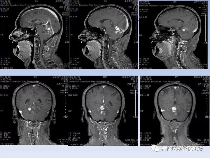 【病例】表现为结节的小脑胶母1例MR