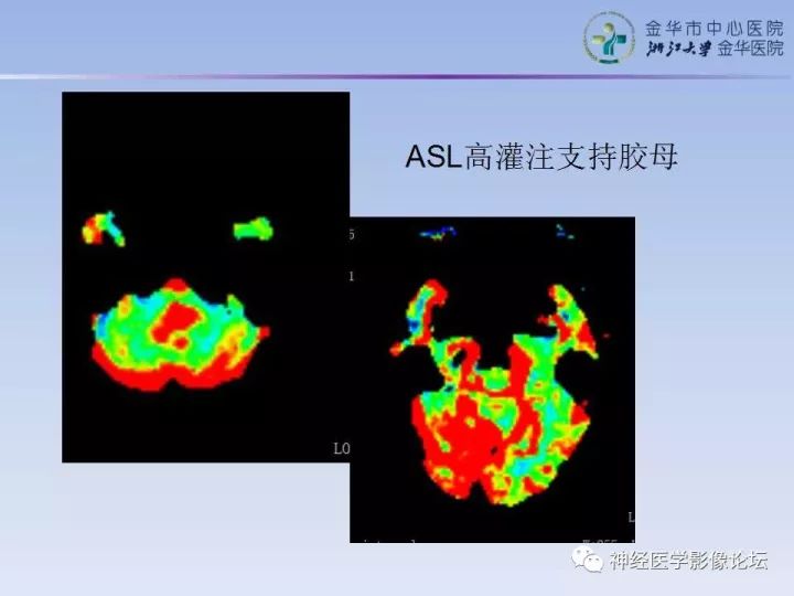 【病例】表现为结节的小脑胶母1例MR
