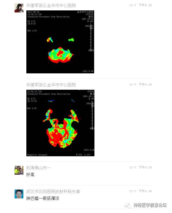 【病例】表现为结节的小脑胶母1例MR