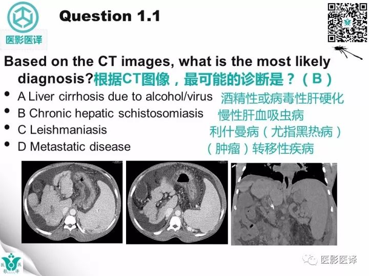 【病例】肝血吸虫病1例CT影像表现