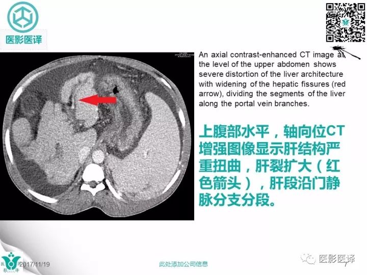 【病例】肝血吸虫病1例CT影像表现