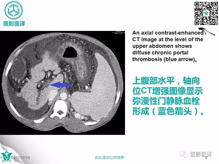【病例】肝血吸虫病1例CT影像表现