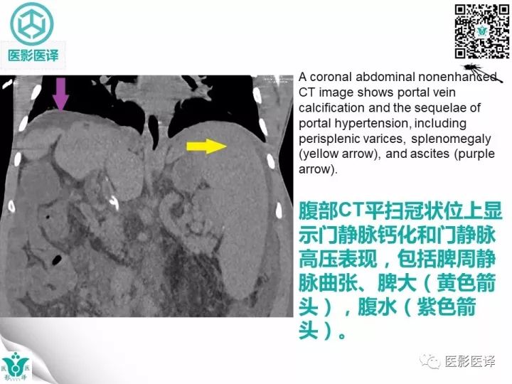 【病例】肝血吸虫病1例CT影像表现
