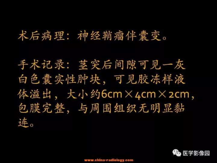【病例】颈部神经鞘瘤1例CT影像表现
