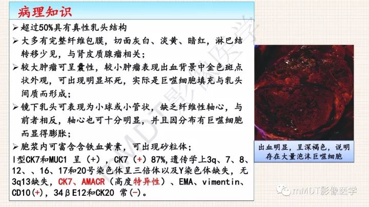 【PPT】乳头状肾细胞癌影像诊断