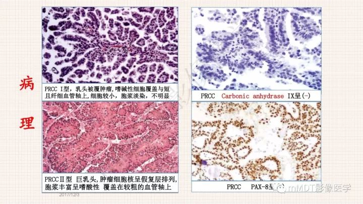 【PPT】乳头状肾细胞癌影像诊断