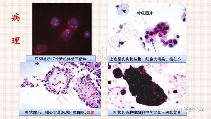 【PPT】乳头状肾细胞癌影像诊断