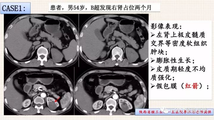 【PPT】乳头状肾细胞癌影像诊断